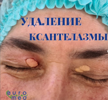 Удаление ксантелазмы